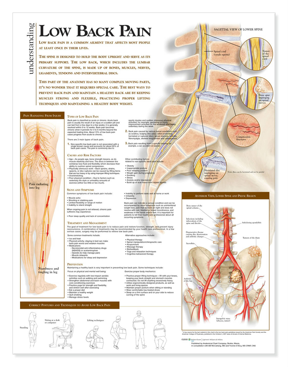 Lower Back Pain - Understanding