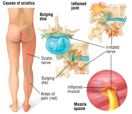 Causes of Sciatica
