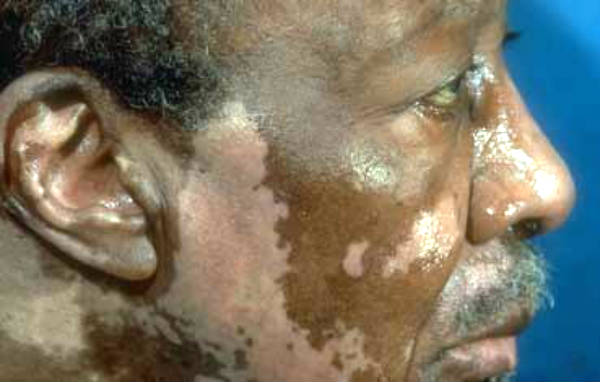 Vitiligo Face