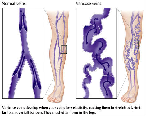 10 Points To The Prevention and Treatment of Varicose Veins 1