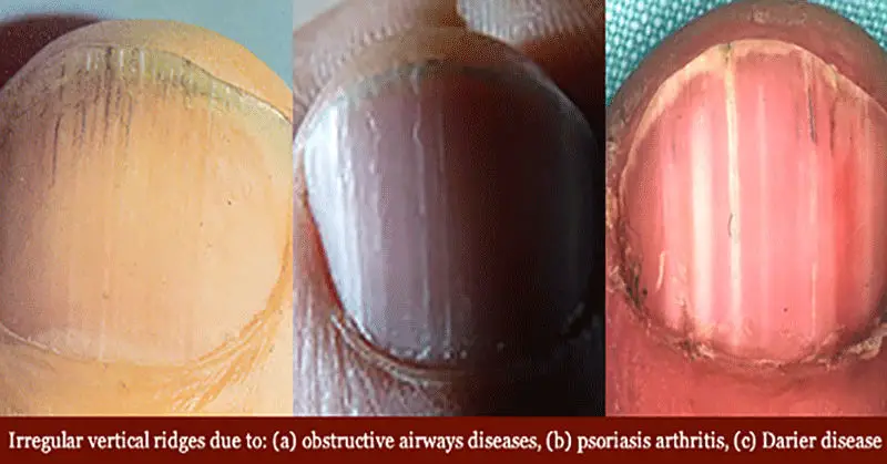 8 Health WARNINGS Your Fingernails May Be Sending