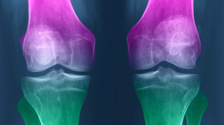 How to Regenerate Knee Cartilage Naturally