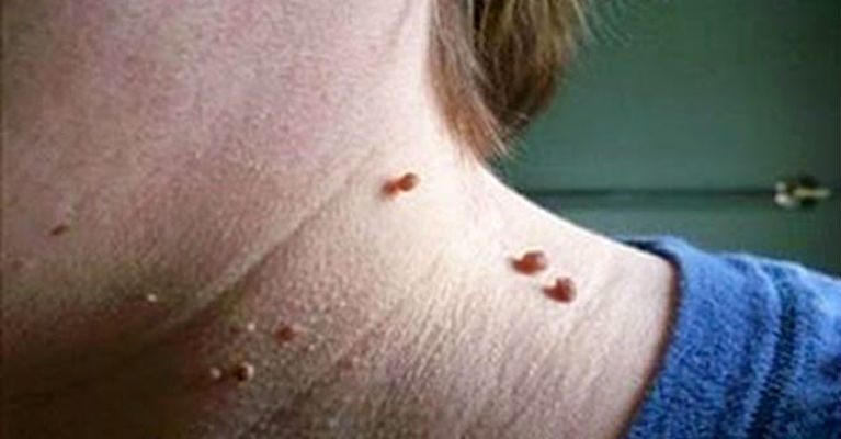 Remove Skin Warts at Your Home Without Using Laser Fibroid ...