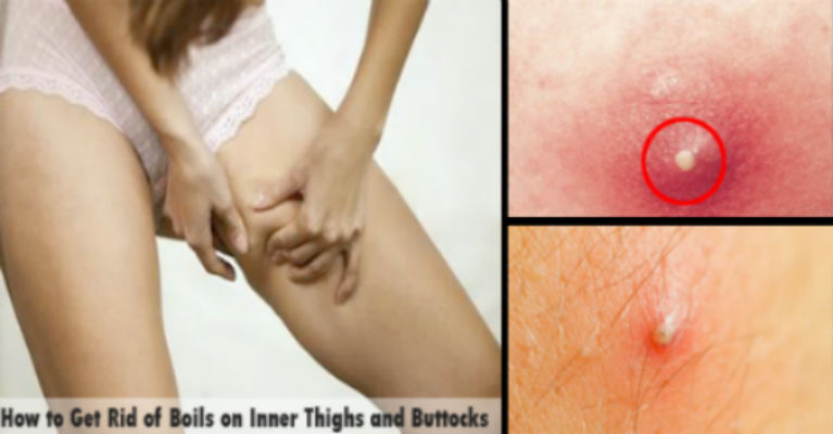 How To Get Rid Of Boils On Inner Thighs And Buttocks