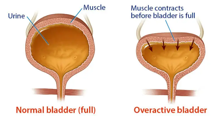 What Causes Overactive Bladder - Blacklist of Foods to Avoid It