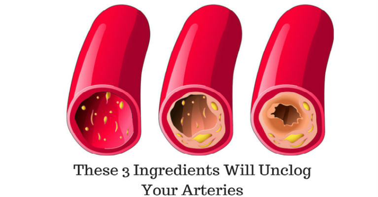 Coronary Arteries Cleanse With Only 3 Ingredients