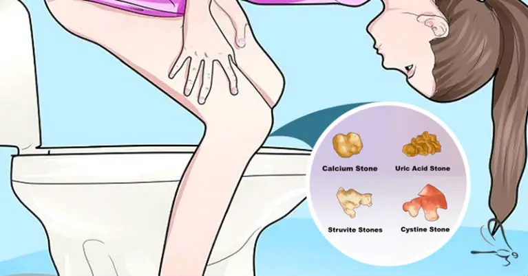 Warning Signs That You'll Get Kidney Stones