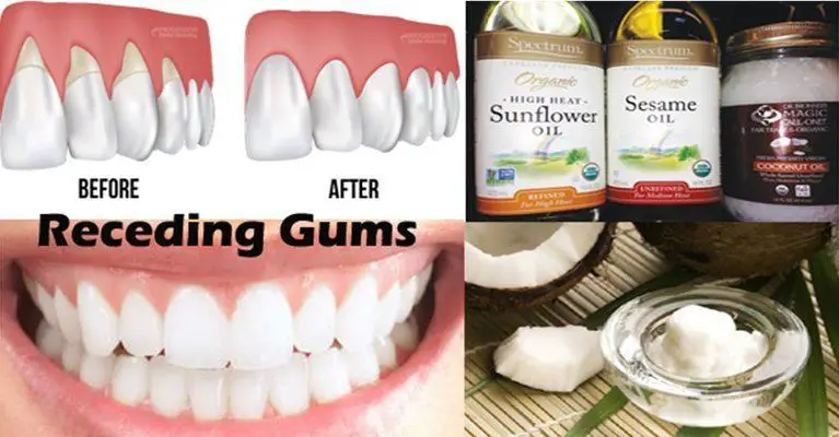 Home Remedies to Grow back Receding Gums