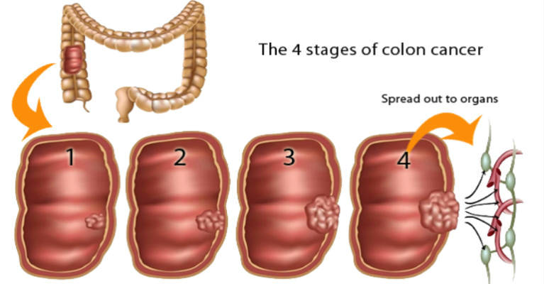 Identifying colon cancer explained