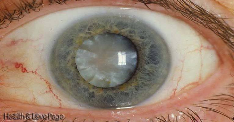 Scientists Have Developed Eye Drops That Can Melt Away Cataracts