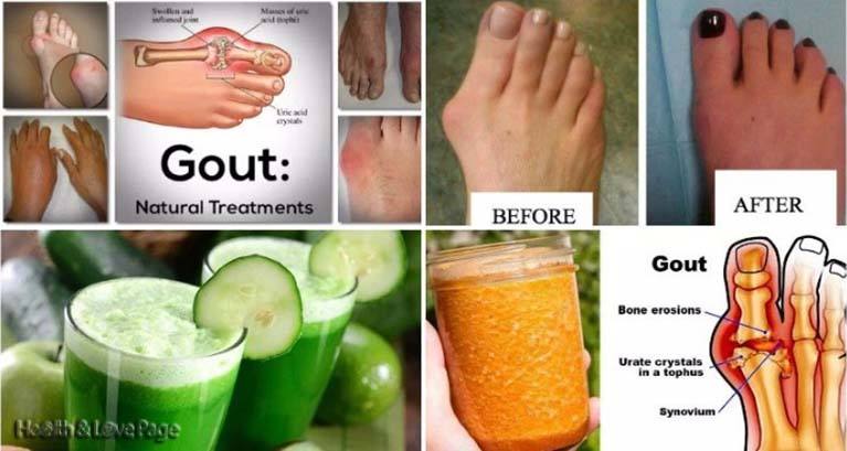 doctors-have-confirmed-beat-the-arthritis-with-this-simple-folk-remedy