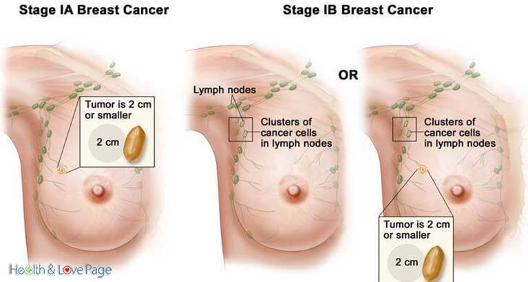 scientists-in-amsterdam-just-destroyed-breast-cancer-tumors-in-11-days-without-chemo