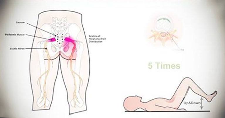Sciatica: Causes, Symptoms, Prevention, and Treatments You Can Try To Heal the Pain