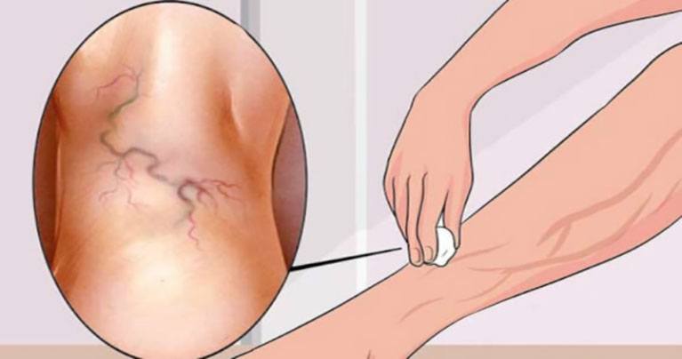 Eliminate Varicose Veins Forever with This Single Ingredient