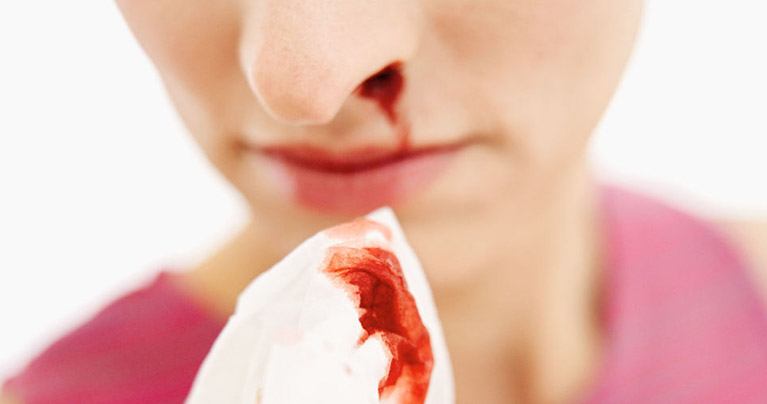 Here's What Causes Nosebleeds and the Right Way to Stop Them