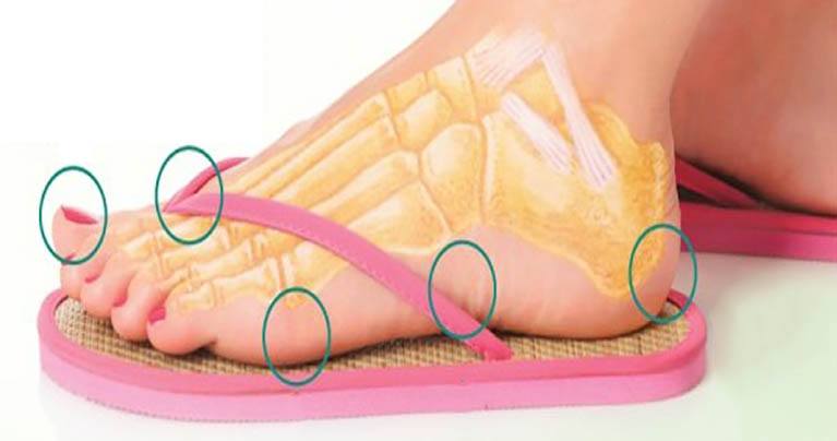5 Ways Wearing Flip Flops Destroys Your Health Without You Noticing