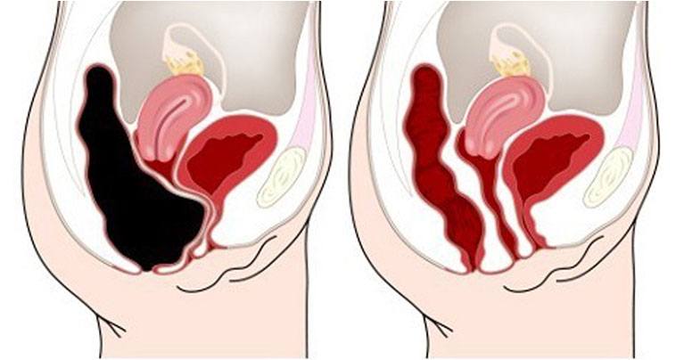 How to Remove 20 Pounds of Toxic Waste from Your Colon - Recipe